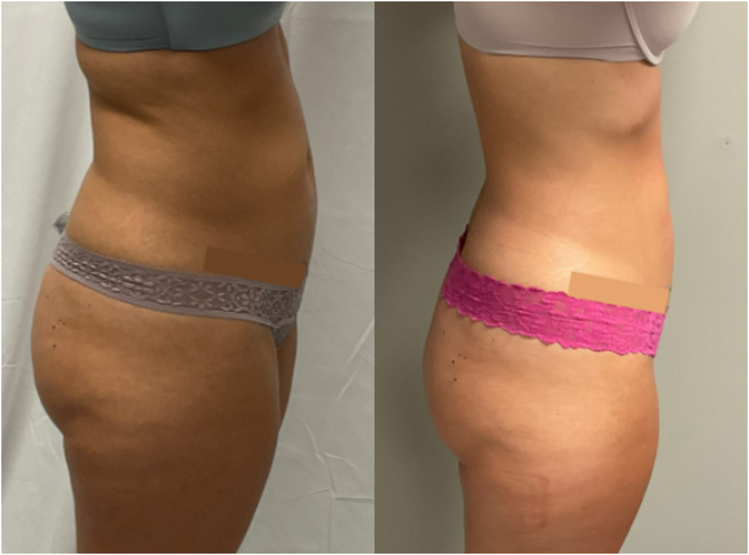 Before and After Results for PHYSIQ Body Contouring