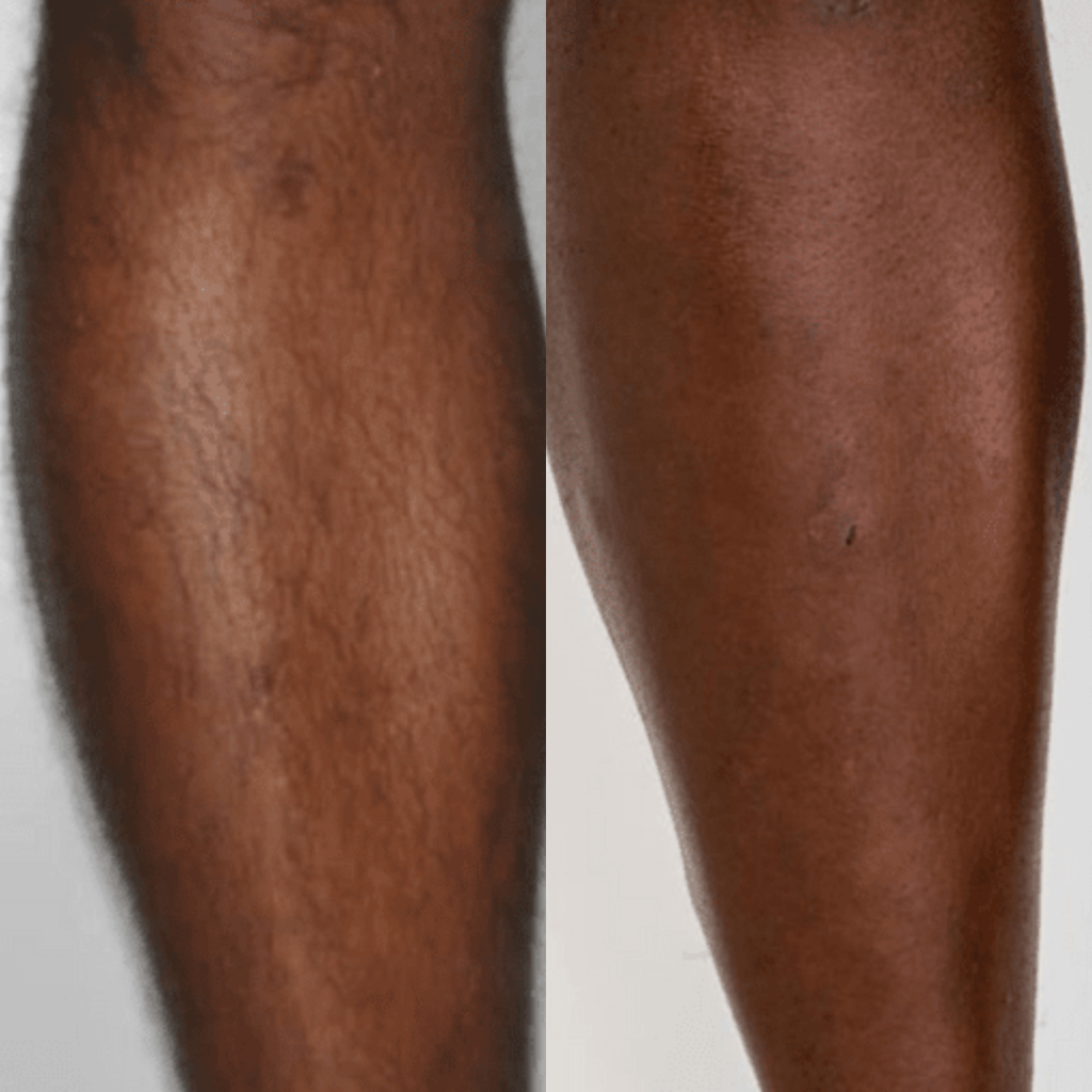 Before and After Laser Hair Removal Results technology